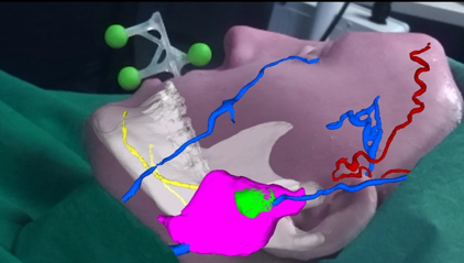 Surgery 4.0: all about augmented reality